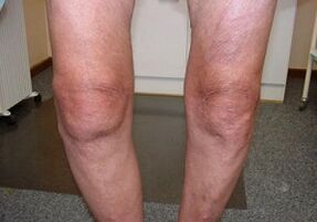 hvordan man behandler arthrose af knæleddet