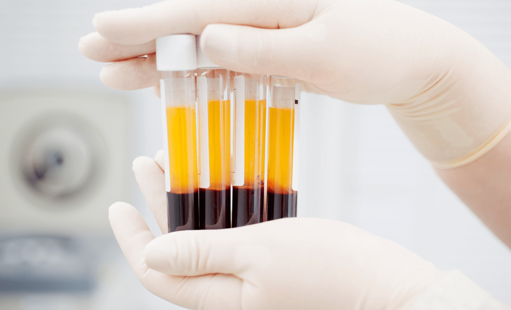 Blodpladerigt plasma til PRP-behandling mod artrose